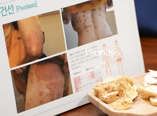 생기한의원 건선 정보, 팔꿈치 건선 각질 반복 시 확인 사항