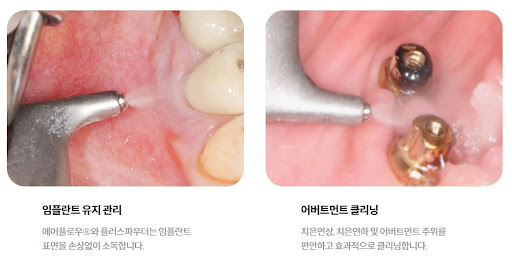 천안 임플란트, 불당본점 서울비디치과의원에서 치아 미백과 임플란트를 한 번에 해결해드립니다